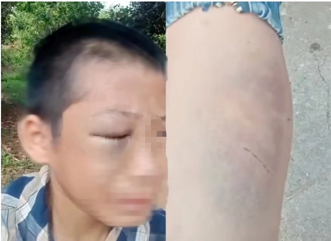 Quyết định của thầy hiệu trưởng trong vụ bé trai nghi bị bạo hành khi sống cùng bố và mẹ kế - Ảnh 1.