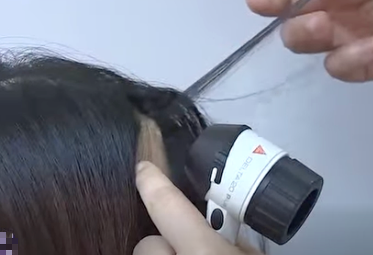 Người trẻ rụng tóc, hói đầu vì những thói quen tưởng vô hại - Ảnh 3.