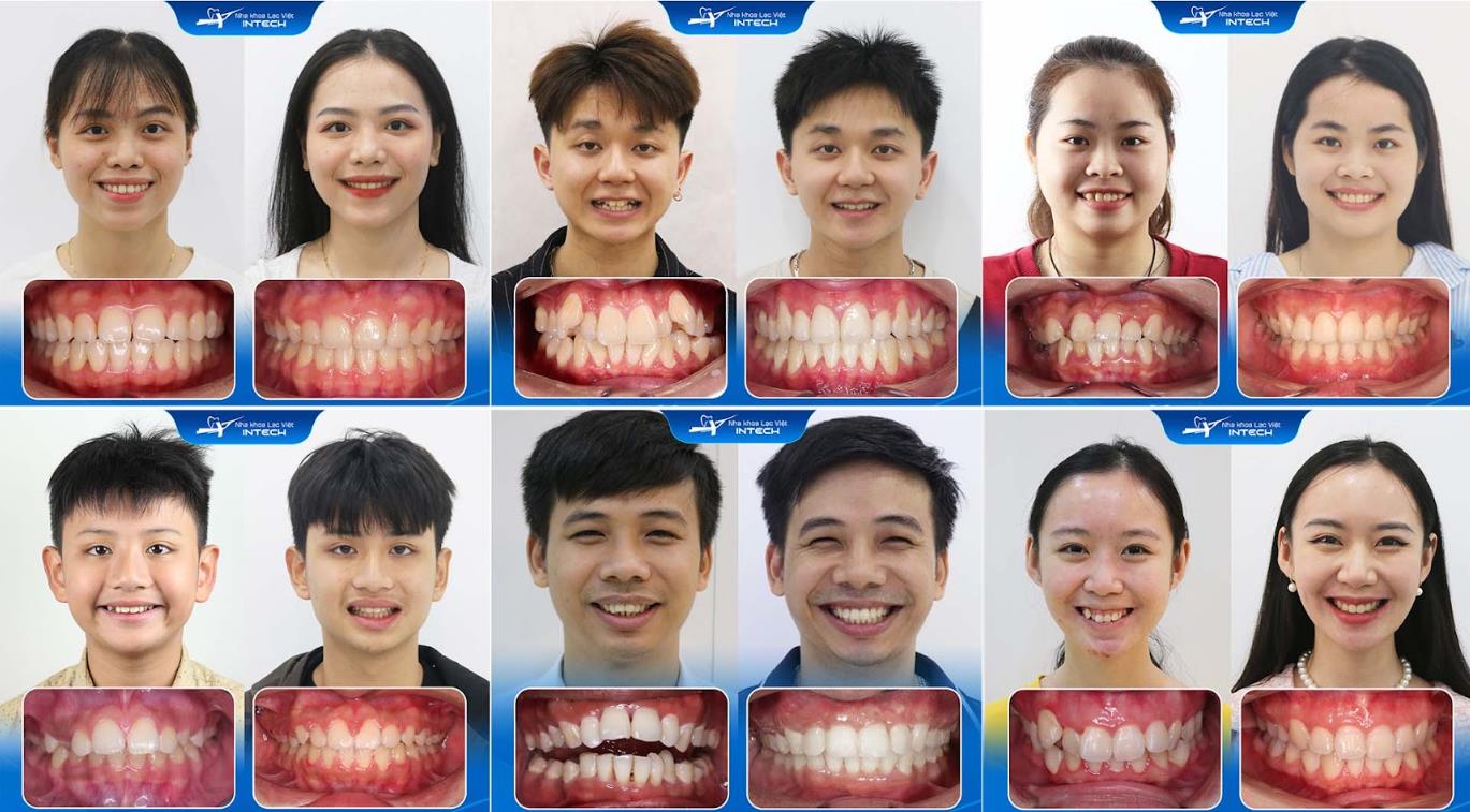 Định nghĩa bác sĩ nha khoa giỏi theo góc nhìn của CEO Nha khoa Lạc Việt Intech - Ảnh 4. Định nghĩa bác sĩ nha khoa giỏi theo góc nhìn của CEO Nha khoa Lạc Việt Intech - Ảnh 4.