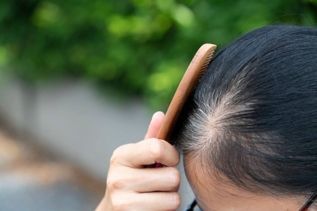 Người trẻ tóc bạc sớm: Bác sĩ chỉ ra 3 dưỡng chất hay bị thiếu hụt, ít người để ý đến- Ảnh 1.