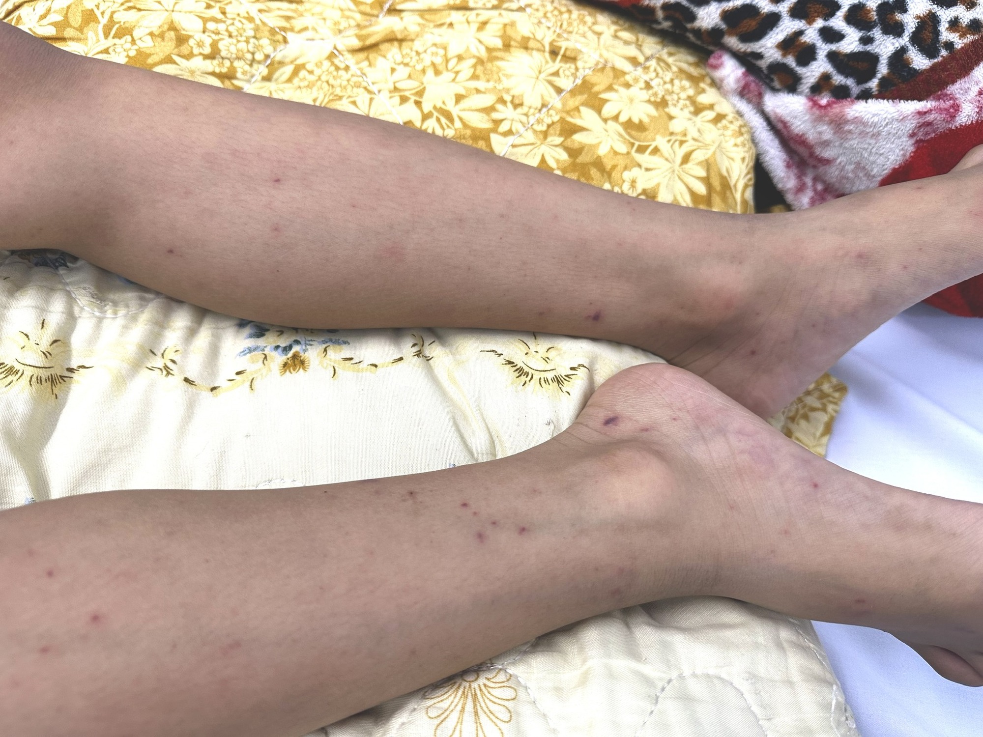 N&atilde;o m&ocirc; cầu tấn c&ocirc;ng trẻ nhỏ, cảnh b&aacute;o nguy cơ tử vong nhanh - Ảnh 2.