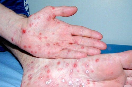 Số ca giang mai tăng đột biến tại TPHCM - Ảnh 1.
