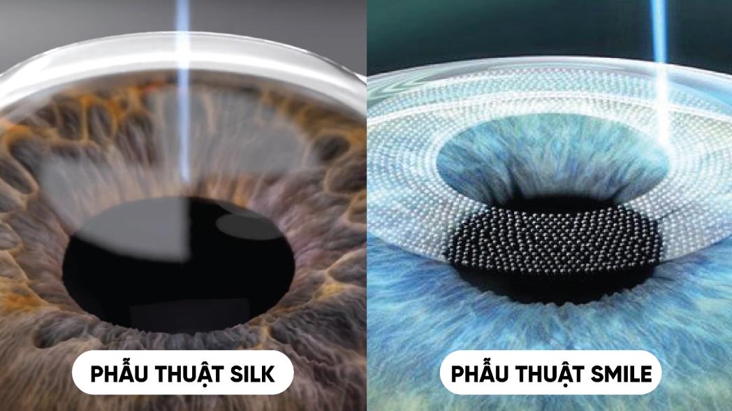 X&oacute;a cận kh&ocirc;ng tạo vạt: V&igrave; sao ng&agrave;y c&agrave;ng được người trẻ quan t&acirc;m? - Ảnh 1.