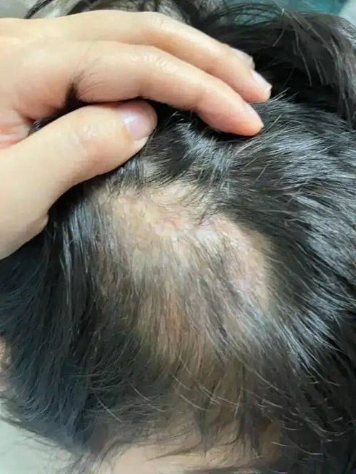 B&eacute; g&aacute;i 5 tuổi rụng t&oacute;c h&oacute;i vĩnh viễn cả 1 mảng v&igrave; 1 h&agrave;nh động tưởng chừng v&ocirc; hại- Ảnh 1.