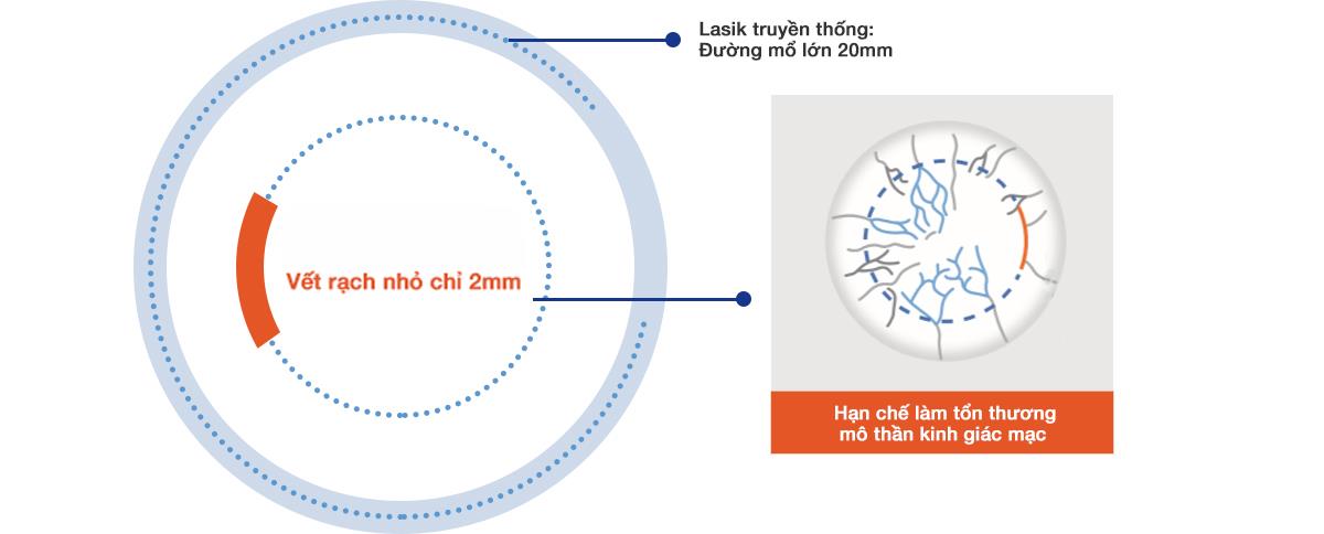X&oacute;a cận kh&ocirc;ng tạo vạt: V&igrave; sao ng&agrave;y c&agrave;ng được người trẻ quan t&acirc;m? - Ảnh 3.