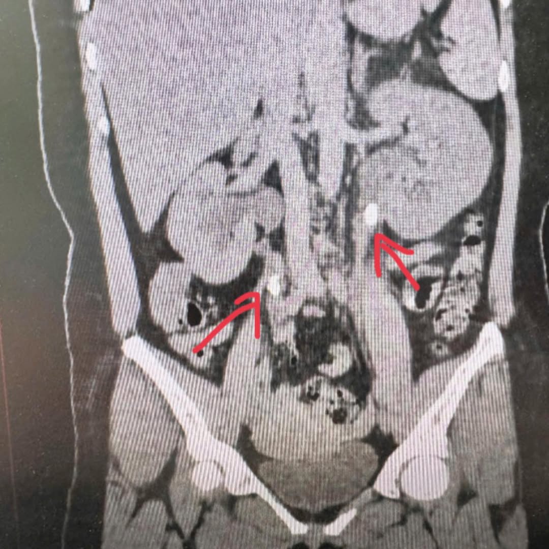 B&aacute;c sĩ giật m&igrave;nh khi xem h&igrave;nh ảnh CT thận của bệnh nh&acirc;n- Ảnh 1.