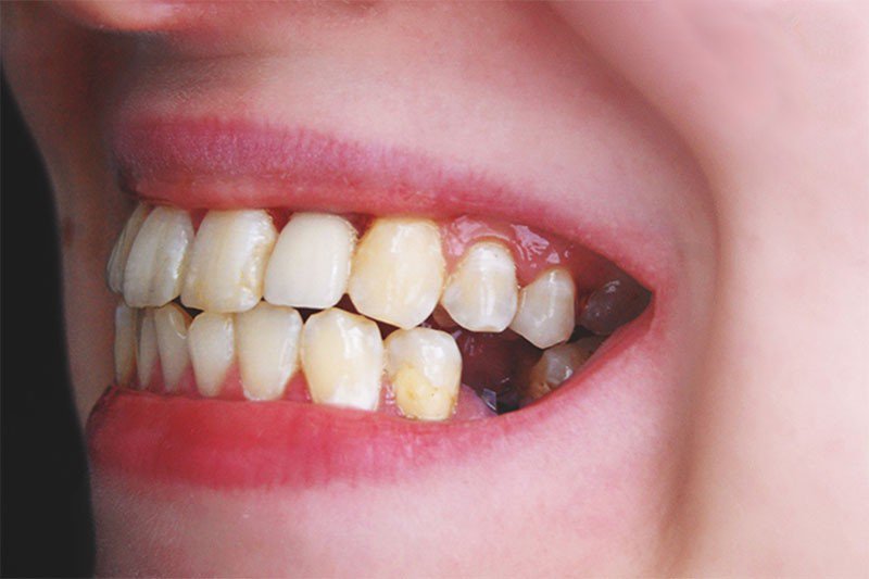 V&igrave; sao nhiều người mất răng nhưng kh&ocirc;ng chịu trồng?- Ảnh 1.