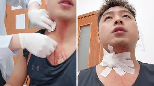 Người đàn ông suýt chết vì cú đập muỗi làm vỡ mạch máu ở cổ - Ảnh 3. Người đàn ông suýt chết vì cú đập muỗi làm vỡ mạch máu ở cổ - Ảnh 3.