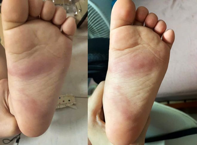 X&aacute;c minh vụ trẻ 3 tuổi bị bầm t&iacute;m ch&acirc;n ở Hưng Y&ecirc;n: Bạo h&agrave;nh trẻ em hay hiểu lầm? - Ảnh 1.