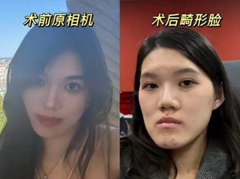 Nữ người mẫu biến dạng mặt lưỡi c&agrave;y sau phẫu thuật thẩm mỹ - Ảnh 1.