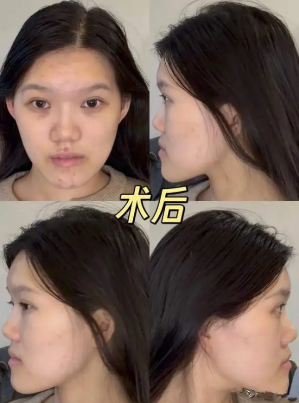 Nữ người mẫu biến dạng mặt lưỡi c&agrave;y sau phẫu thuật thẩm mỹ - Ảnh 2.