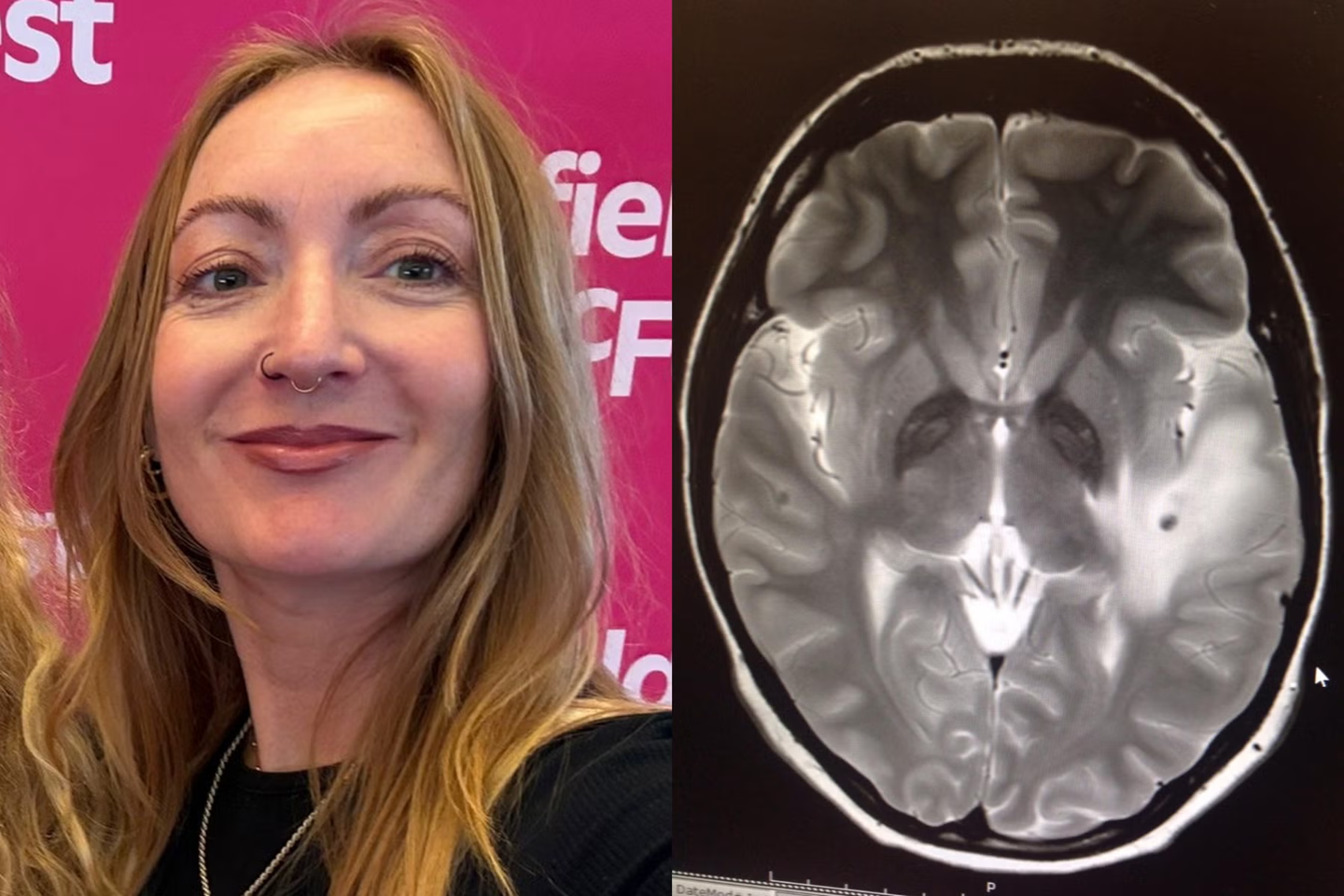 Du lịch 3 th&aacute;ng, c&ocirc; g&aacute;i bị 38 k&yacute; sinh tr&ugrave;ng cư tr&uacute; trong n&atilde;o- Ảnh 2.