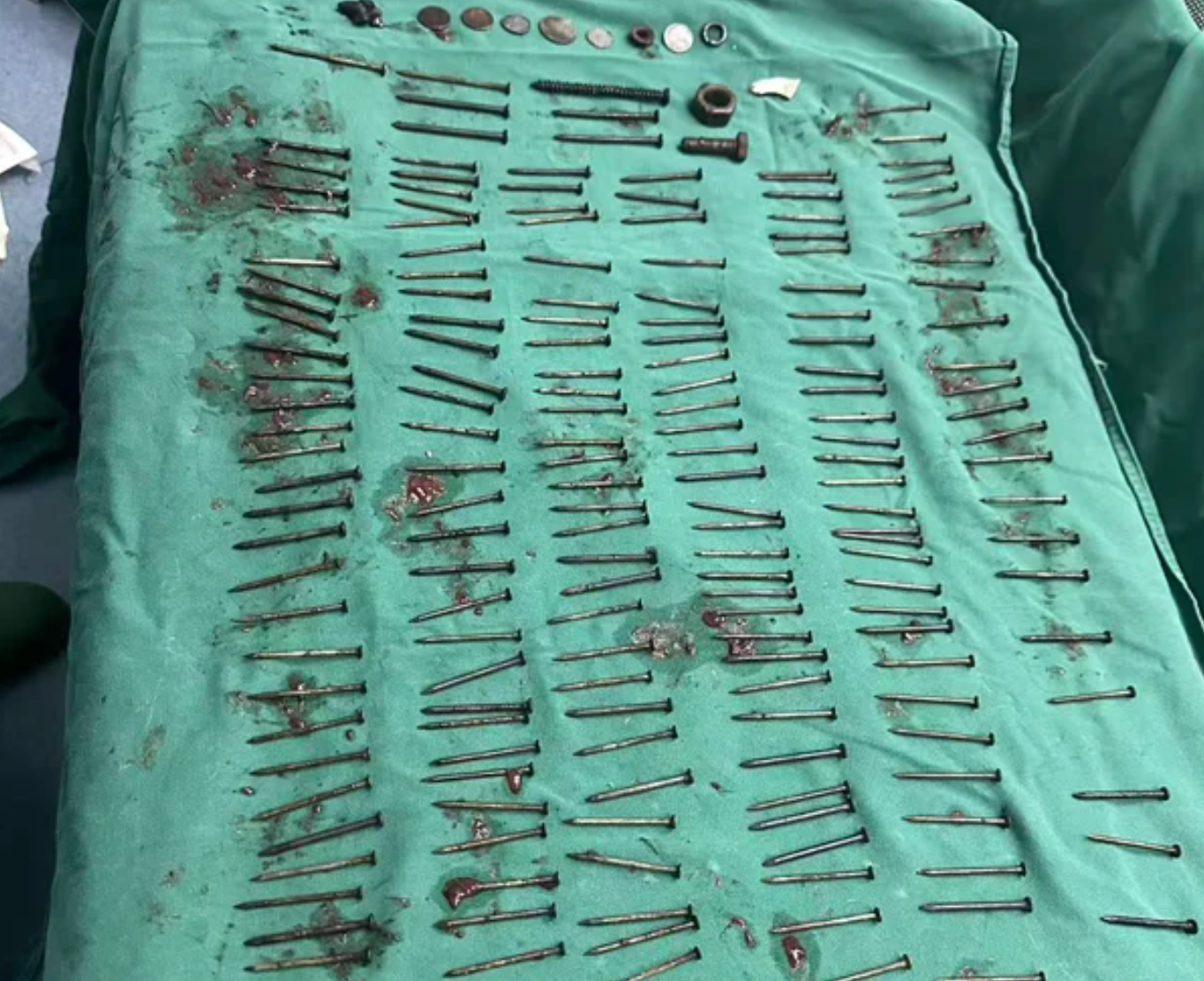 Người đ&agrave;n &ocirc;ng đau bụng, b&aacute;c sĩ kinh ngạc lấy ra 180 chiếc đinh c&ugrave;ng h&agrave;ng loạt kim loại- Ảnh 1.