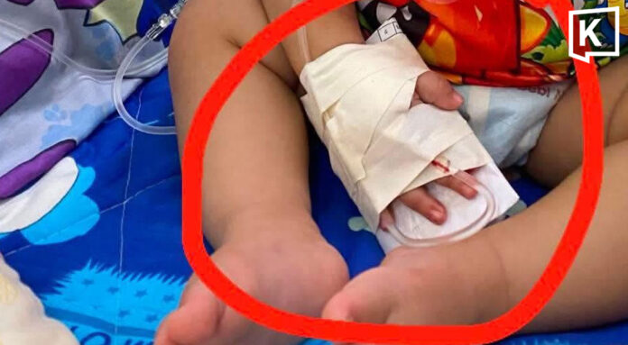 B&eacute; 1 tuổi phải phẫu thuật nối ng&oacute;n tay nghi do nh&acirc;n vi&ecirc;n y tế cắt tr&uacute;ng trong l&uacute;c th&aacute;o kim truyền- Ảnh 1.