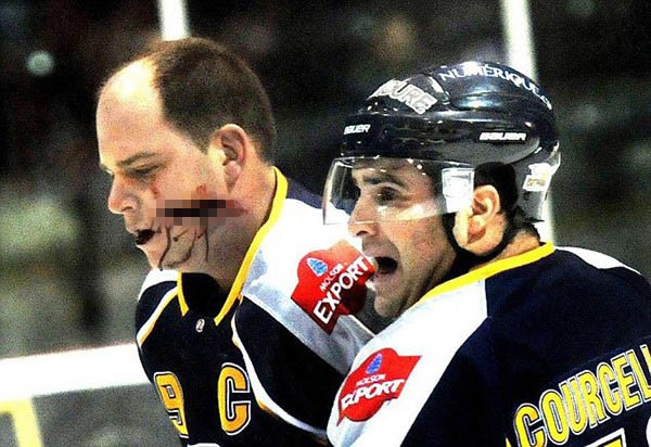 VĐV hockey trở lại với khuôn mặt “zombie” sau chấn thương kinh hoàng 1