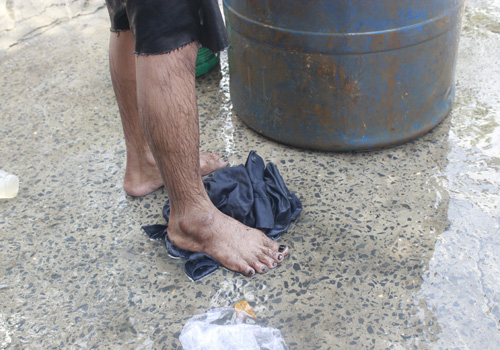 
	Các móng chân của công nhân rúc cống bị nhiễm độc đen ngòm.