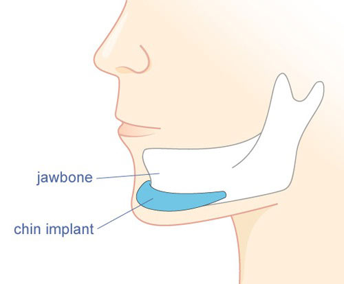 Cận cảnh phẫu thuật độn cằm, Làm đẹp, tham my, lam dep, cham soc da, thời trang, làm đẹp, thẩm mỹ, tin,