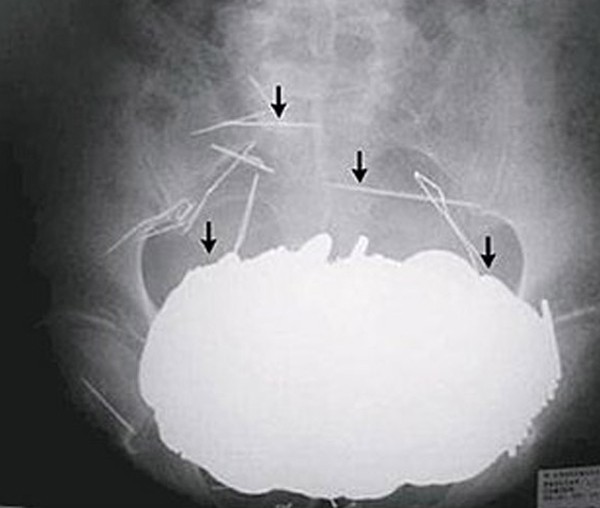 Nhẫn, gián, tóc, đinh, lưỡi dao lam... tìm thấy trong dạ dày người 1