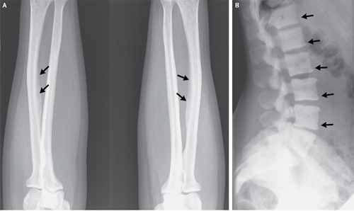 Hình chụp X quang cho thấy xương bị đặc bất thường - Ảnh: New England Journal of Medicine