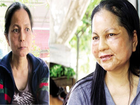 Nguyễn Thị Ngọc Mai sau khi đi Đài Loan điều trị trở về (bên phải) và Nguyễn Thị Ngọc Mai hiện tại