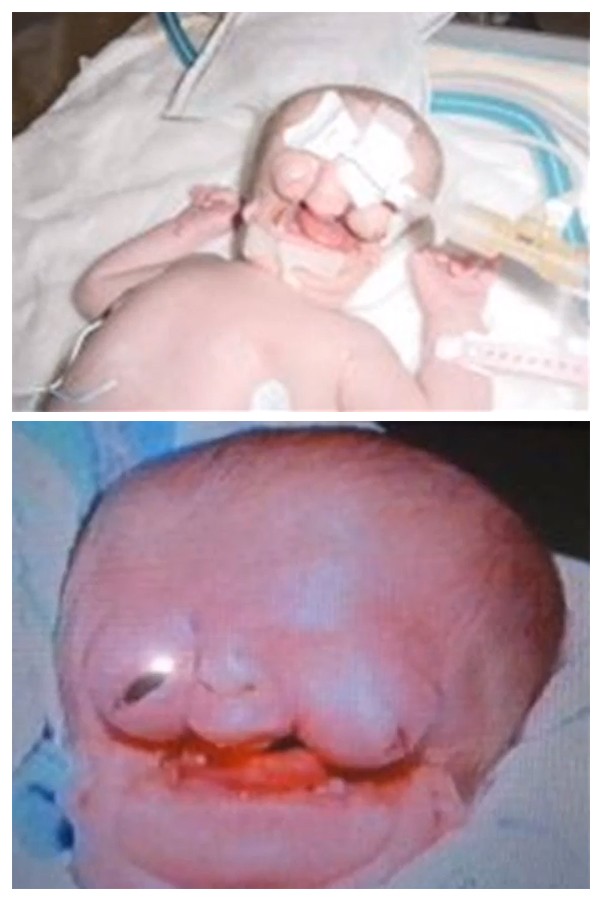 Đáng thương hoàn cảnh bé gái sinh ra không có mặt mũi 1