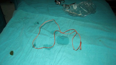 Sợi dây điện dài gần 1m được gắp ra từ bàng quang - Ảnh: BS Phạm Ngọc Thạch
