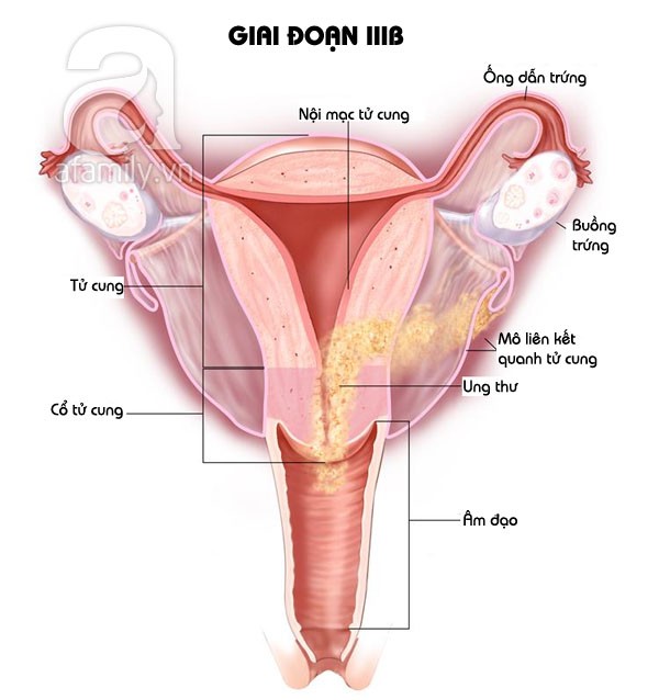 Nhìn tận mắt các giai đoạn của ung thư nội mạc tử cung 4