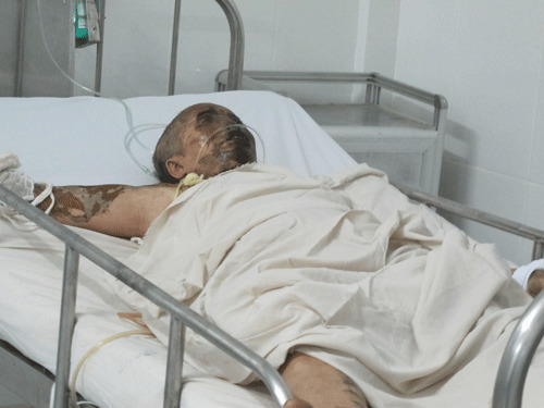 Một phụ nữ bị tạt axit khi đang ngủ