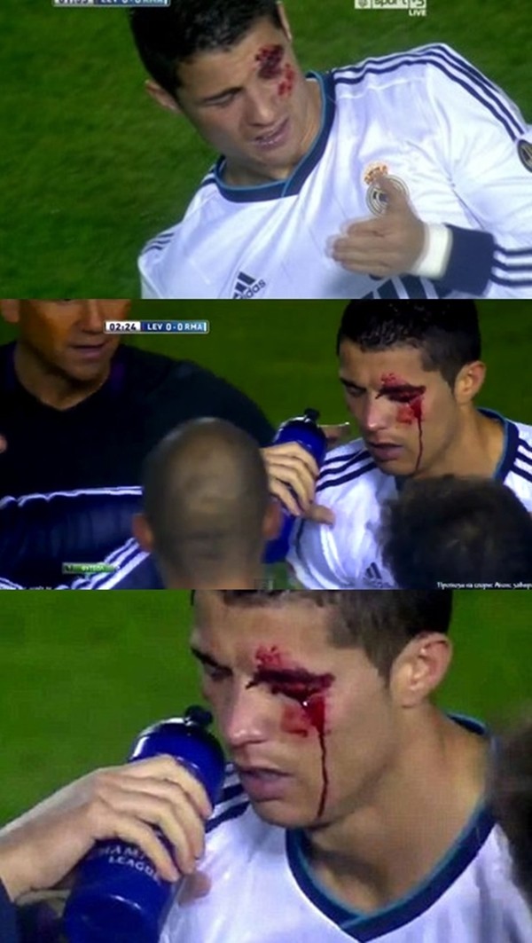 Điểm lại những lần đổ máu vì chấn thương của Ronaldo 8