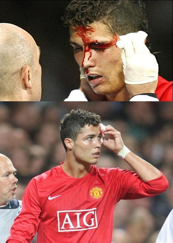 Điểm lại những lần đổ máu vì chấn thương của Ronaldo 10