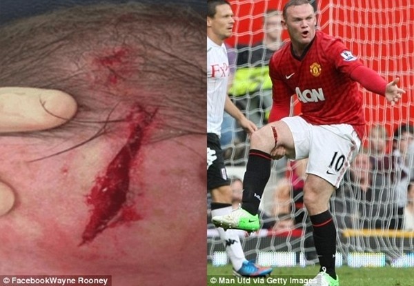 Dính chấn thương đầu, Rooney sở hữu sẹo giống hệt Harry Potter