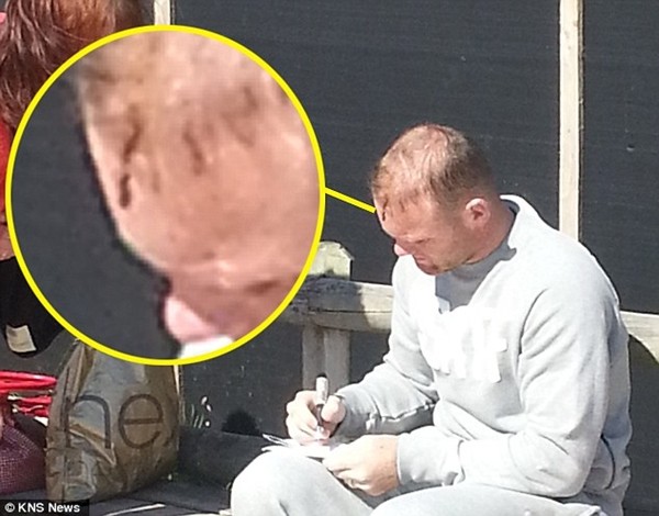 Dính chấn thương đầu, Rooney sở hữu sẹo giống hệt Harry Potter