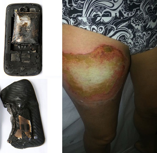  	Chiếc Galaxy S3 bị nổ và vết bỏng trên người cô gái