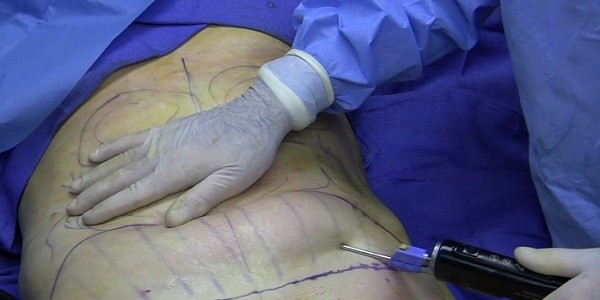 Cận cảnh quy trình phẫu thuật thẩm mỹ - hút mỡ bụng 3
