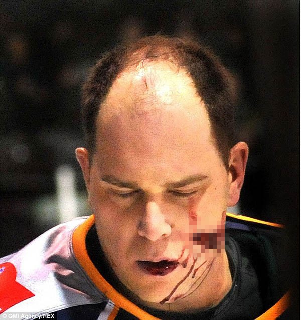 VĐV hockey trở lại với khuôn mặt “zombie” sau chấn thương kinh hoàng 2