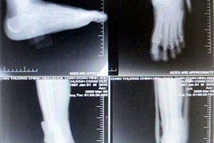 
	Một bệnh nhân chụp cổ bàn chân ở 4 tư thế đã bị cắt ghép phim.