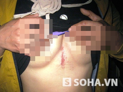 
	Một số vết xước, bầm tím trên cơ thể mà chị Hoa khẳng định bị công an xã đánh.