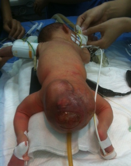
	Khối u nặng 0,5kg ở vùng hậu môn của bé gái trước ca phẫu thuật.