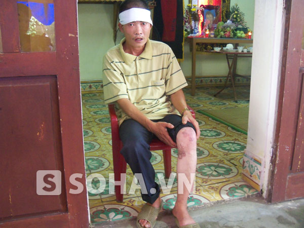 Anh Đặng Vinh Quang (hay còn gọi tên khác là Côn, SN 1969, anh trai của hung thủ Đặng Ngọc Viết), là nạn nhân chất độc màu da cam.