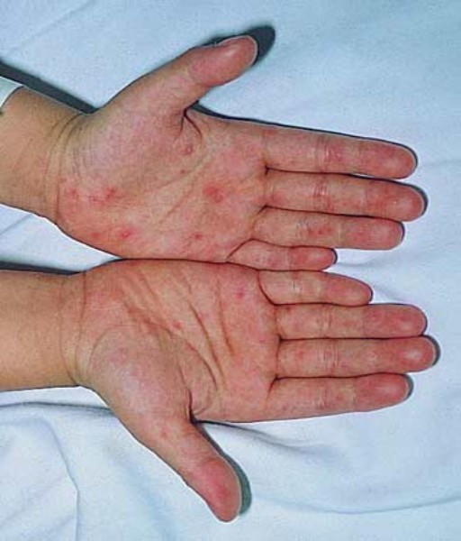 Bệnh TCM, sốt xuất huyết đang "tấn công" trẻ em