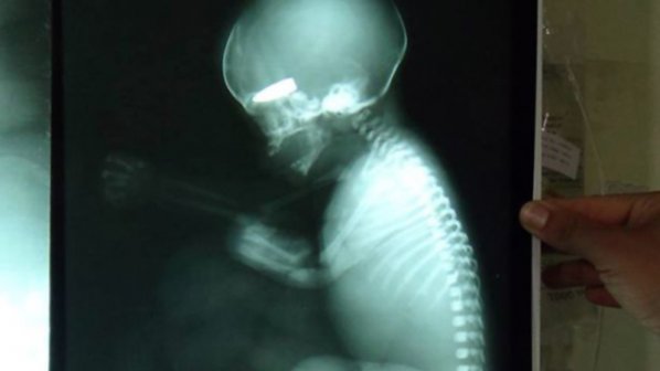 
	Một tấm phim X-quang chụp bào thai bị trúng đạn ở đầu. 