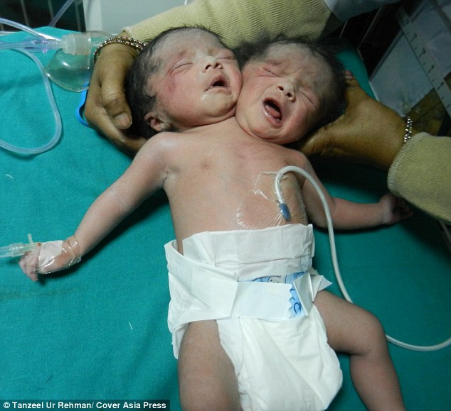 Bi thảm: Cặp song sinh dính liền Ấn Độ sinh ra với một cơ thể và hai đầu đã qua đời sau khi chiến đấu để tồn tại trong một đáng chú ý 20 ngày