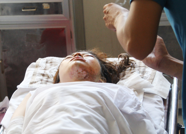 Hồng Kim Huôi bị Dũng tạt axit vào mặt đang điều trị tại bệnh viện Chợ Rẫy. Ảnh: Châu Thành