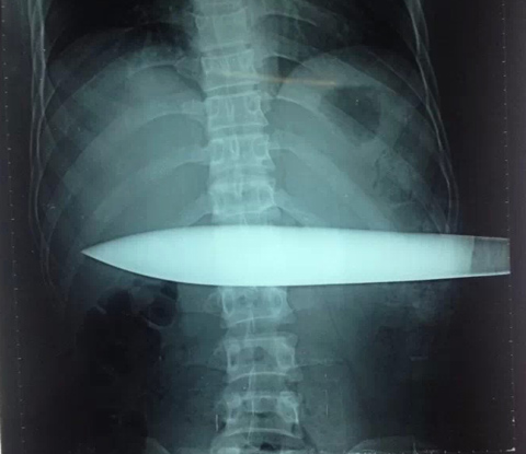 Hình ảnh X quang cho thấy con dao đâm gần hết phần bụng của nạn nhân - Ảnh: Bác sĩ cung cấp