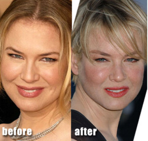 Plastic surgery fails, Renee Zellweger - Photo courtesy of likes-media