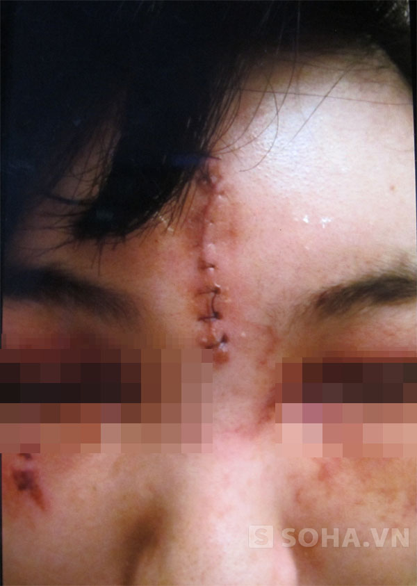 Nhát chém 3cm cùng nhiều vết thương khác trên khuôn mặt và khắp người, Phương đang phải điều trị tại Bệnh viện E.