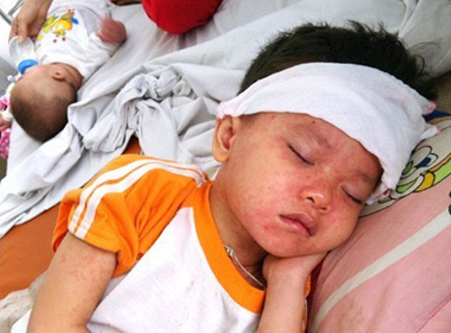 Hình ảnh trẻ em mắc bệnh sởi được điều trị tại Bệnh viện Nhi Trung ương.
