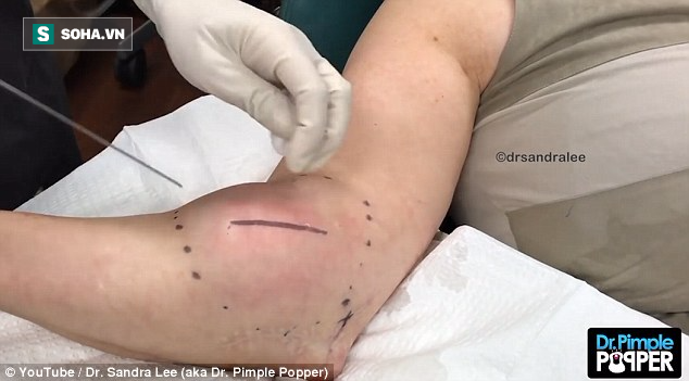 Kinh hoàng video loại bỏ khối u nằm trên cánh tay một người phụ nữ - Ảnh 1.