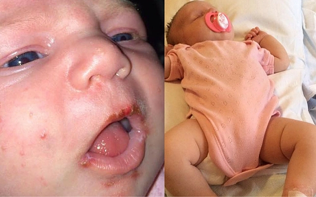 14 tháng tuổi bị nhiễm virus Herpes cả đời do nụ hôn từ người lớn - Ảnh 3.