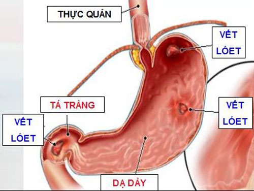 Bấm huyệt nội quan để chữa bệnh đau dạ dày, xuất tinh sớm - Ảnh 1.